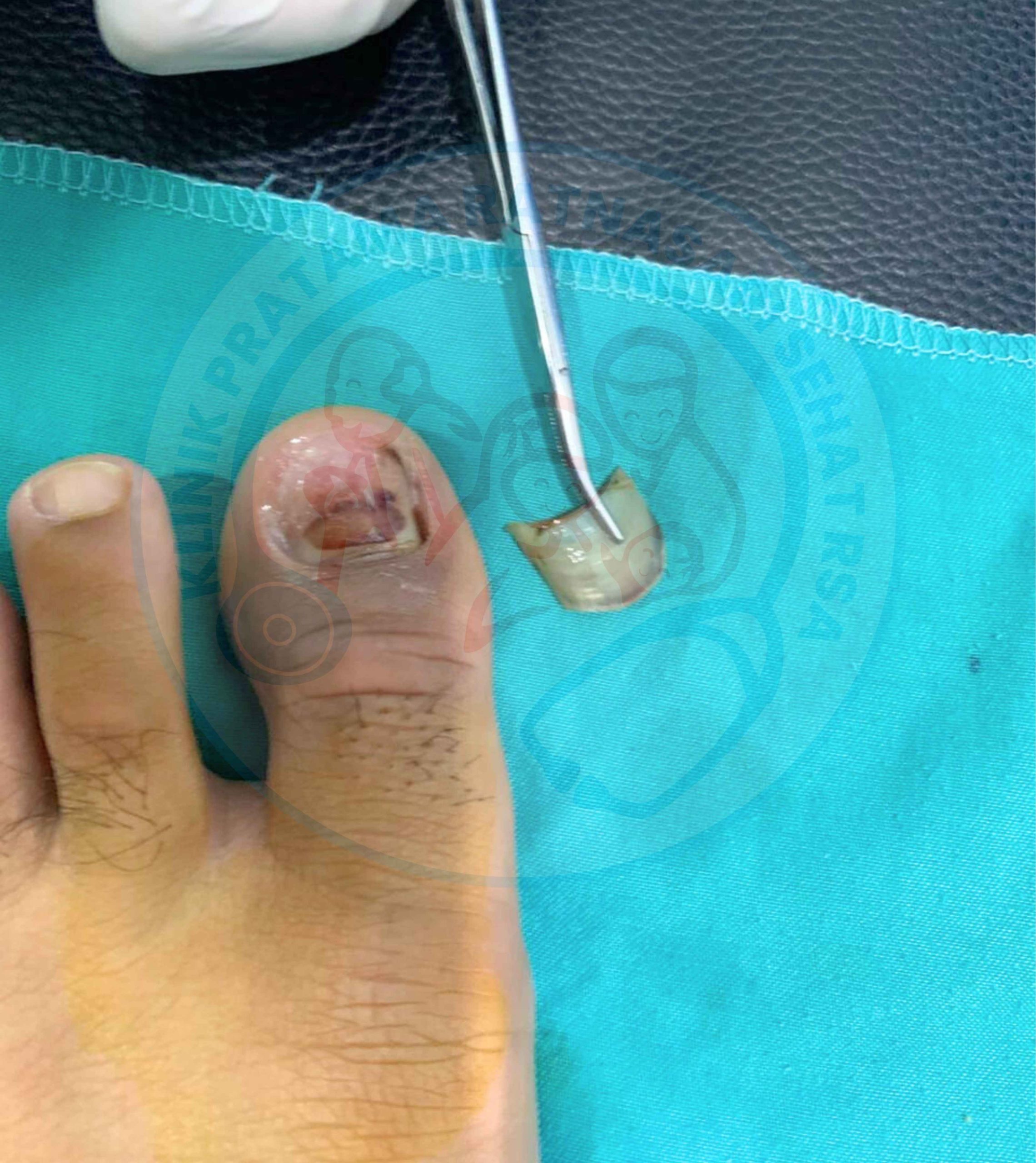 Cantengan Kaki Inilah Penyebab dan Cara Penanganannya