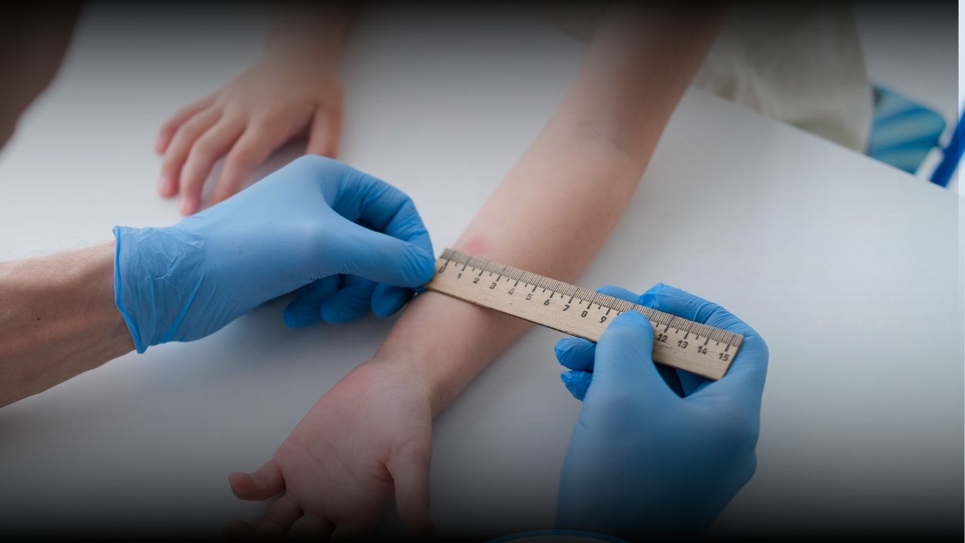 Tes Mantoux di Bandung di Klinik Ratnasari Sehat